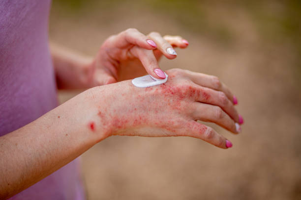 Eczema Cream